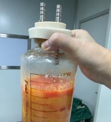 辽宁水动力吸脂手术要做多久？